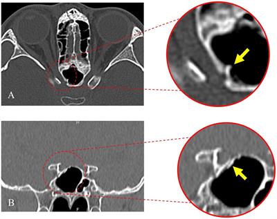Diagnosis and treatment of transnasal endoscopic optic canal decompression for traumatic optic neuropathy